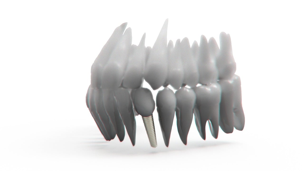 teeth, jaw, 3d model, orthodontics, the implant, teeth, teeth, teeth, teeth, orthodontics, orthodontics, orthodontics, orthodontics, orthodontics
